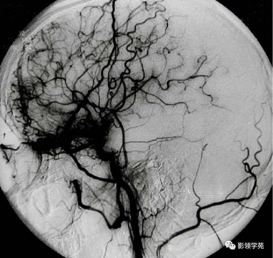 6种常见脑血管疾病影像诊断