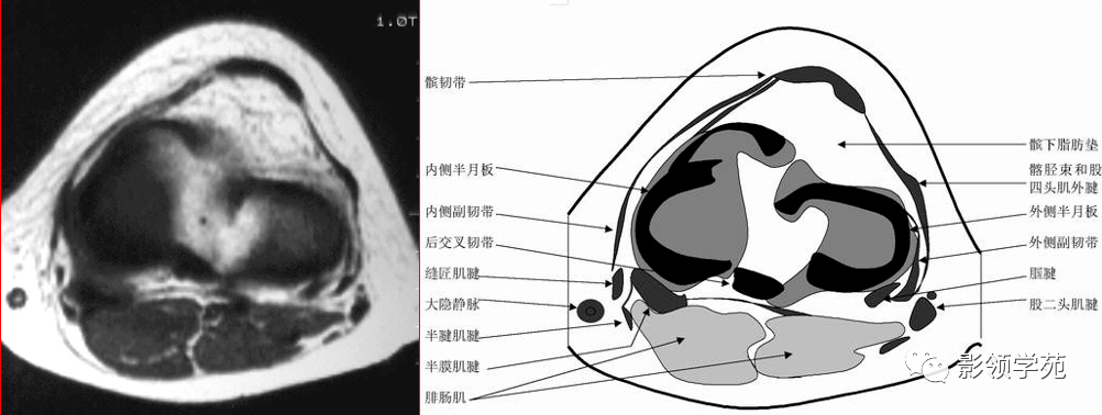 交叉韌帶解剖及損傷的mri診斷