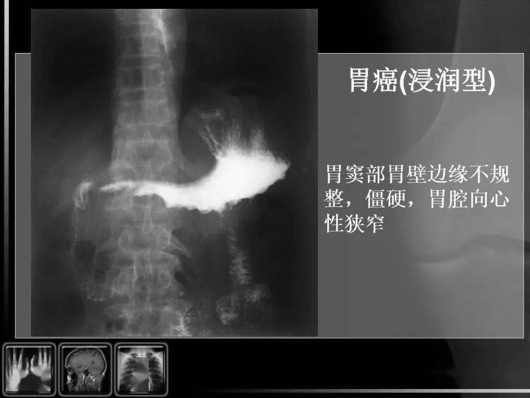 汇总消化道疾病影像诊断与鉴别