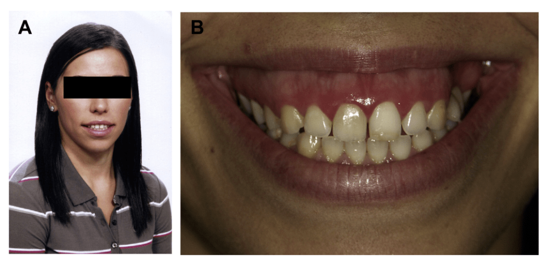 露龈笑治疗方法之上唇再定位_手术