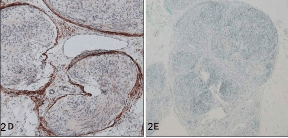 今日病例丛状神经鞘瘤伴局限性多毛症