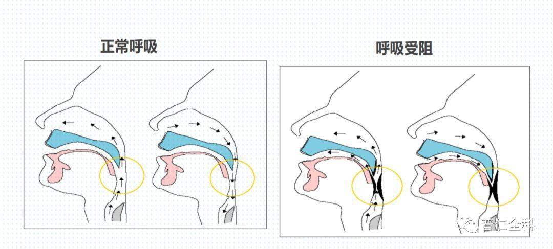 ⑤長期酗酒:引起舌肌麻痺,導致舌體的後墜.④身體肥胖.