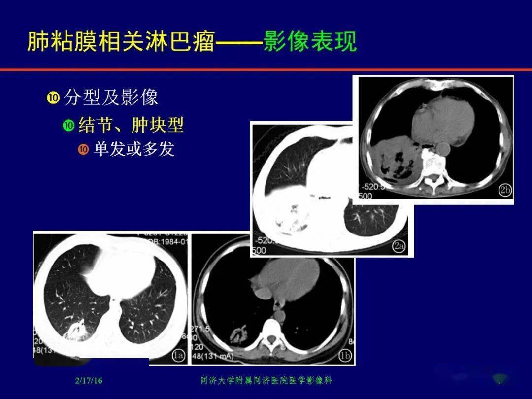 肺粘膜相关淋巴瘤影像诊断