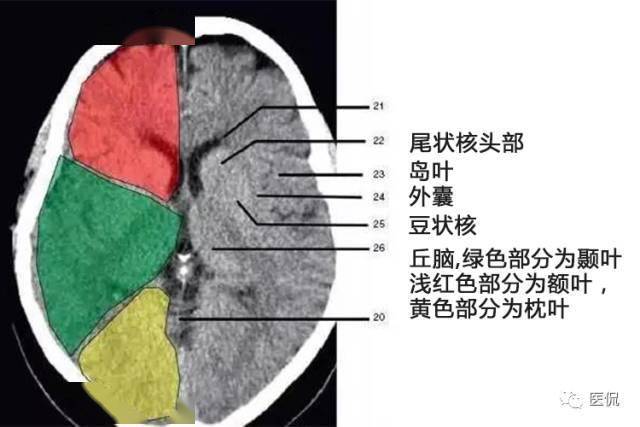 顱腦ct解剖口訣及彩色解剖圖