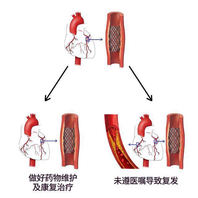 謠言粉碎機冠脈介入手術後不需要進行心臟康復