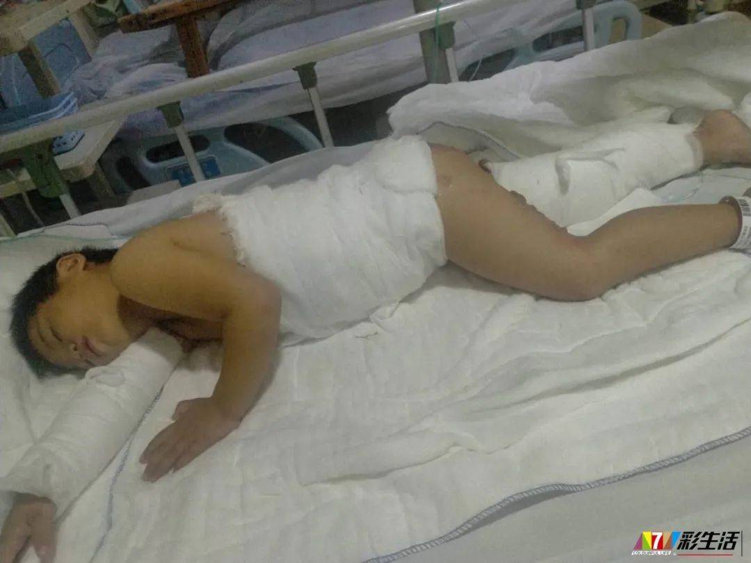 东田3岁小女孩全身25%烫伤!