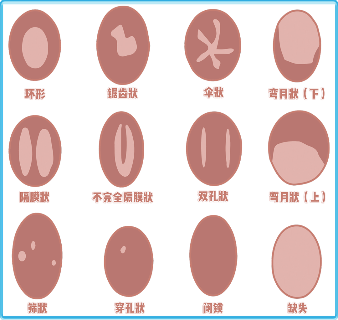 正常來說缺口大小完全能容納一根衛生棉條,使用正確不會對處女膜造成