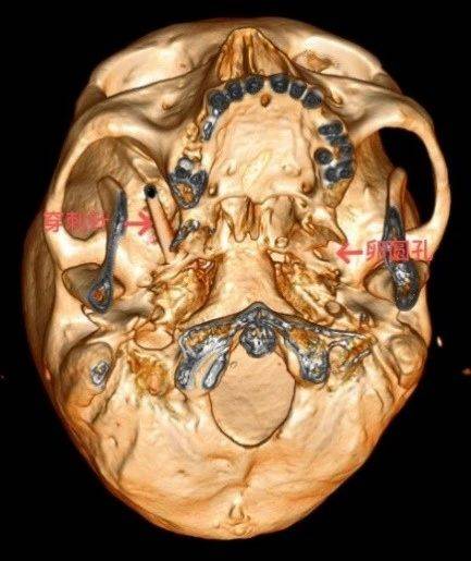 颅底三维重建三叉神经半月节球囊压迫(pbc)术,是国内外公认治疗顽固性