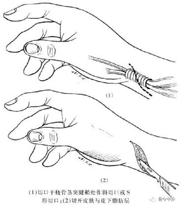 bouchard结节远端指关节—heberden结节指关节退行性变多见青少年及手