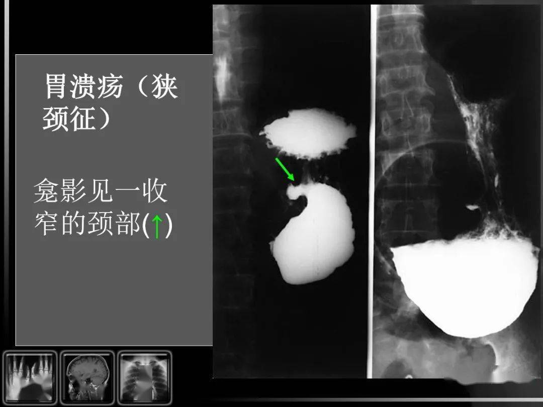 消化道疾病影像诊断与鉴别_造影