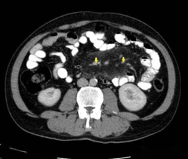 肠系膜淋巴结ct图片