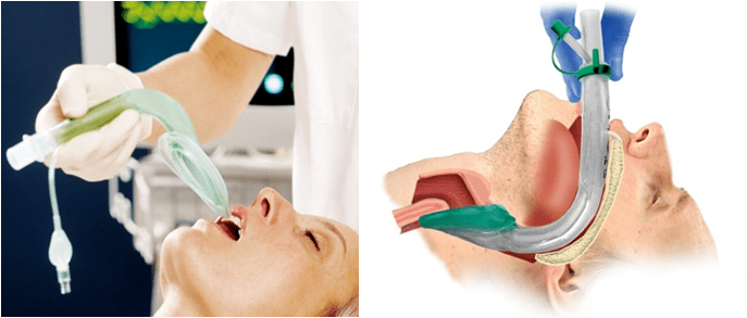 从可视喉镜,可视光棒,可视喉罩,可视双腔管到纤支镜均已广泛应用于