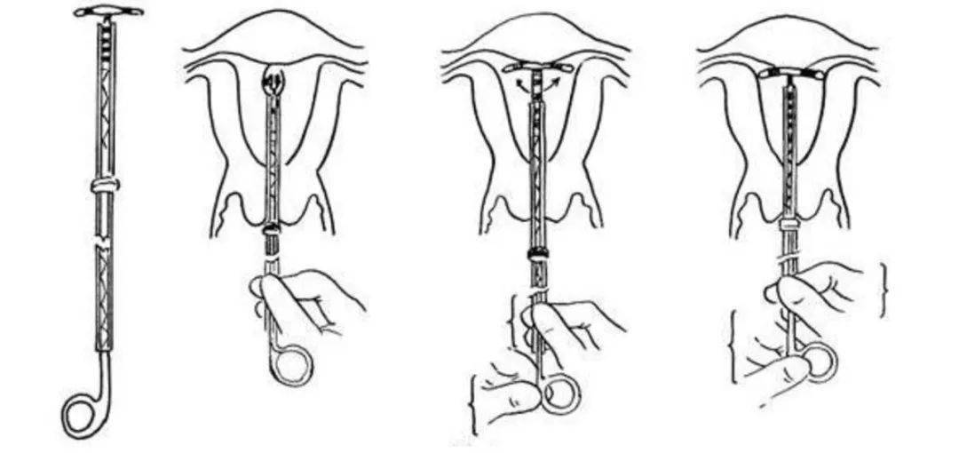 被遗忘在女人体内的节育环该取出来了