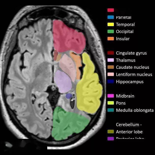 解剖丨脑叶分布(mri图像彩色标注)_lobes