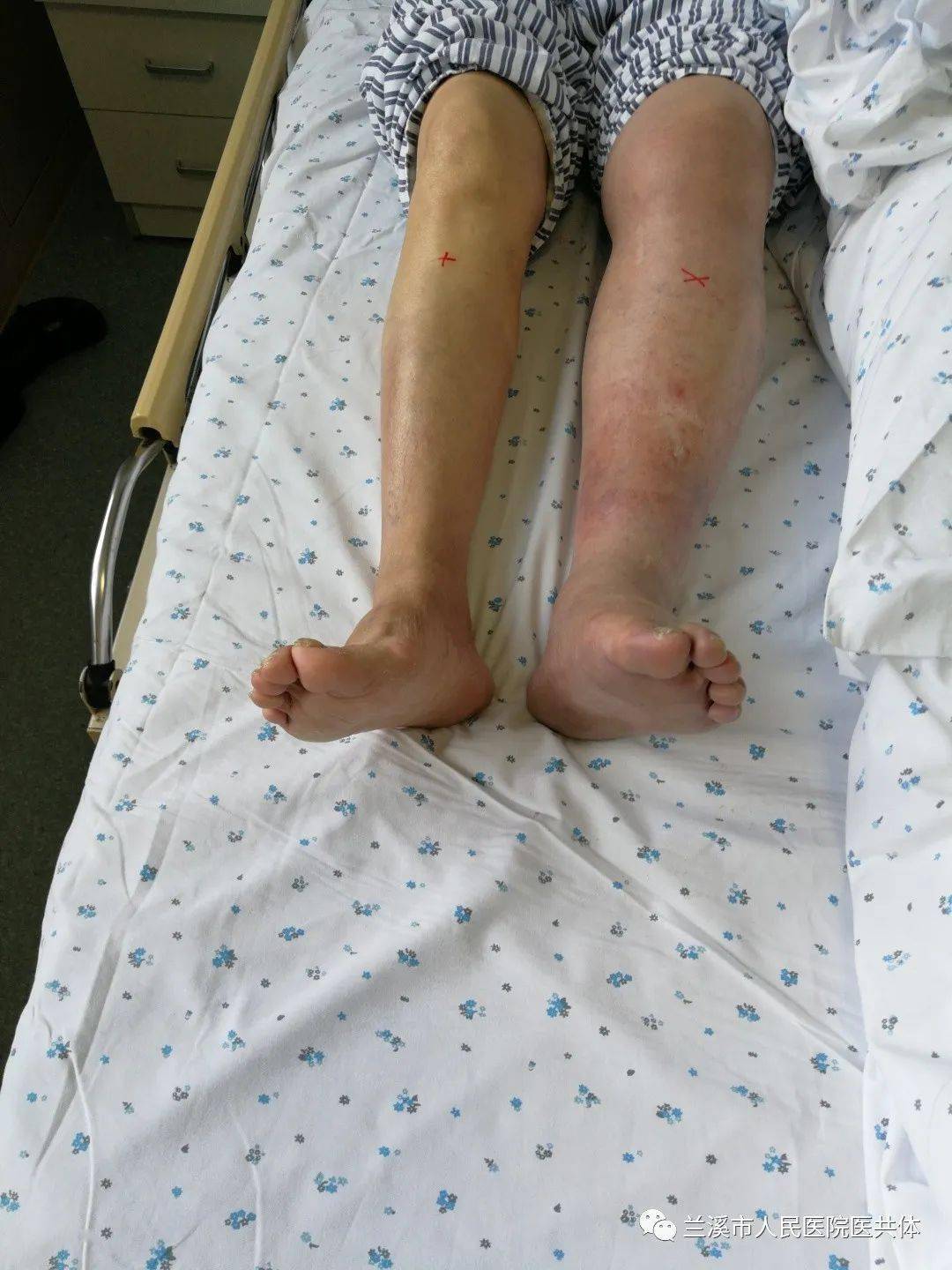 早期下肢静脉血栓图片图片