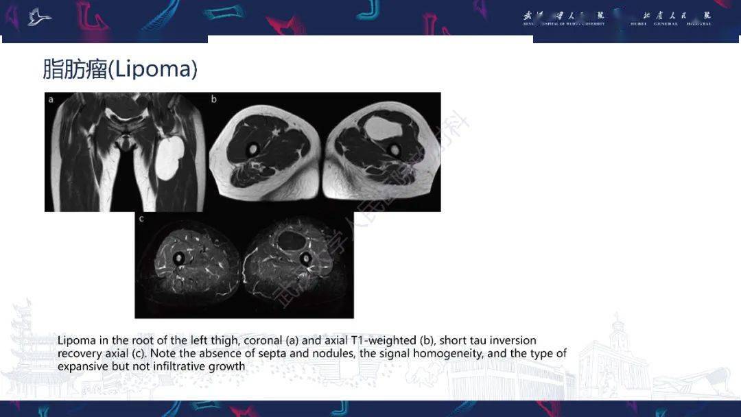 非典型脂肪瘤樣腫瘤影像診斷