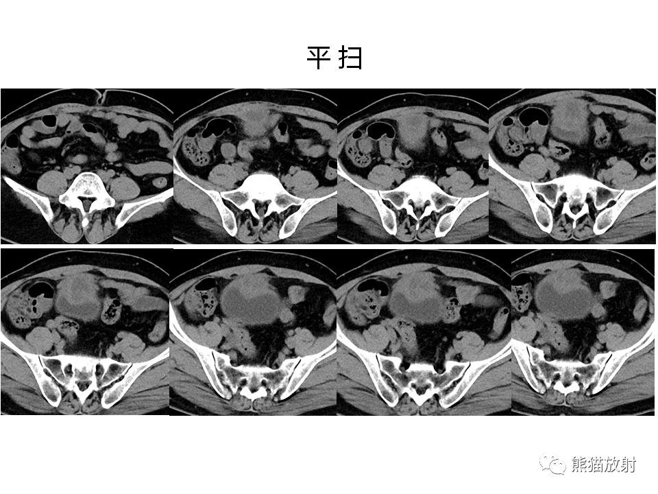 脐尿管脓肿↓ 相关内容链接:【专题】脐尿管畸形与脐尿管癌的ct表现