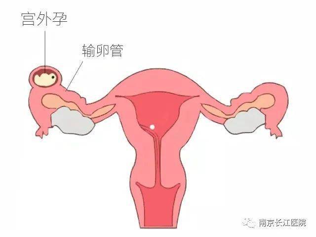 【長江報喜】宮外孕切除左側輸卵管,如今備孕又遇右側輸阻 多囊