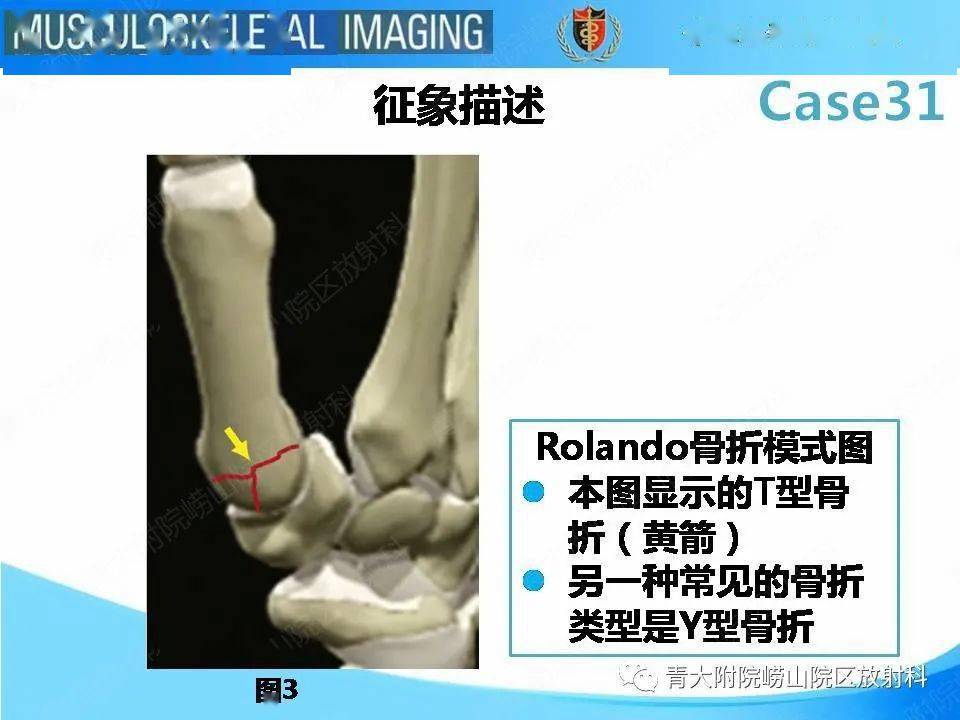 rolando骨折图片图片