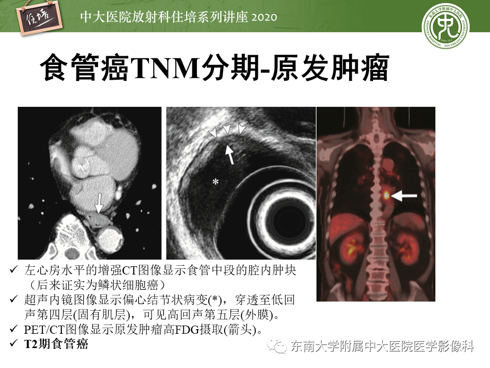 【中大放射住培系列讲座】食管癌影像-临床分期