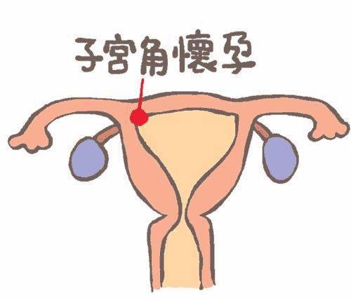 宫角妊娠图片 位置图图片