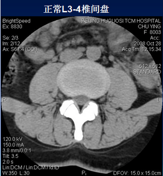 腰椎ct诊断 椎间盘突出