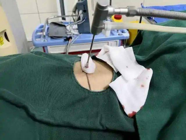 从-196℃到80℃,我国自主研发的"康博刀",在宁夏