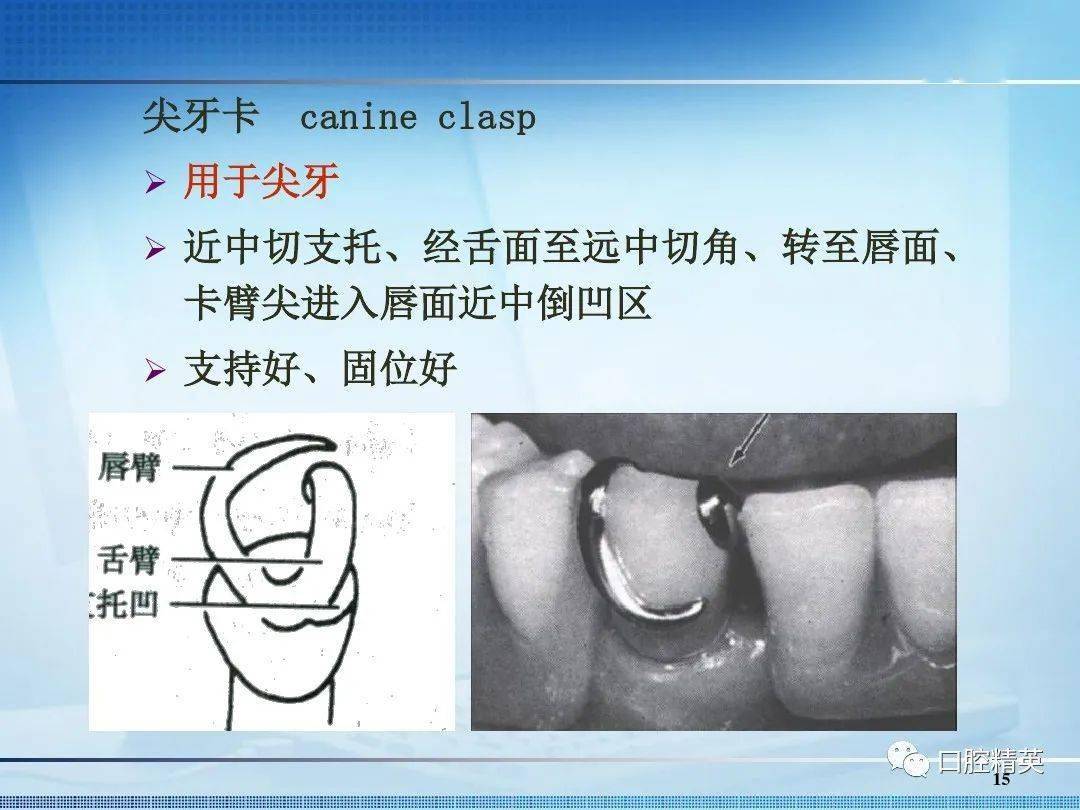 口腔rpi卡环设计图片图片