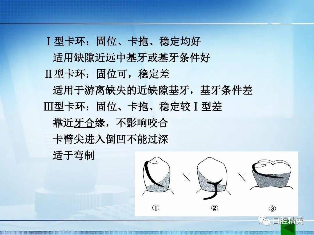 可摘局部义齿卡环的种类