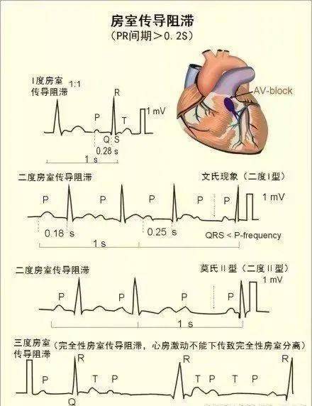 图解版心血管系统知识汇总,简单易懂,值得收藏!_心电图