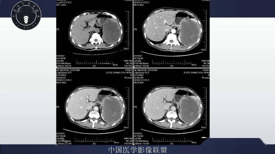 一脾开繁四十天不加脾怎么回事？