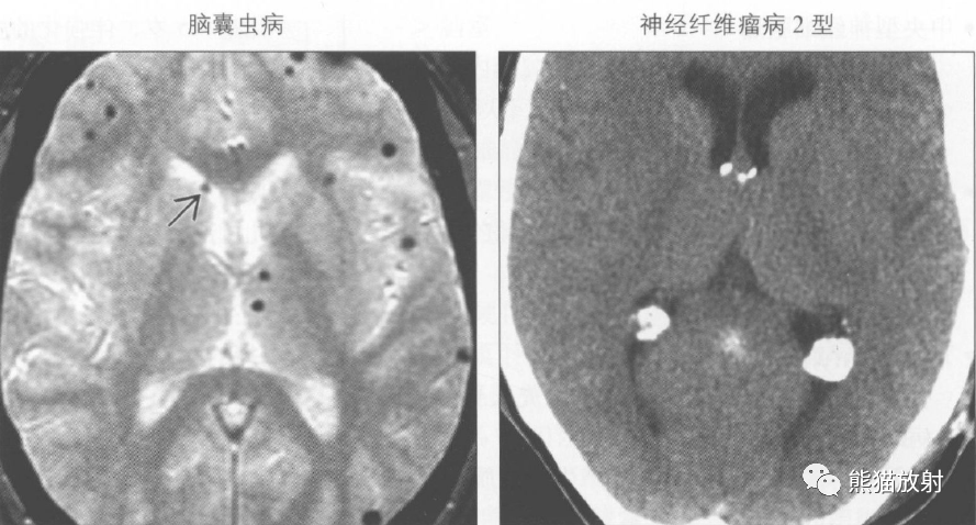 第四腦室常見 30歲以下腦鈣化最常見的原因 神經纖維瘤病2型 非腫瘤性