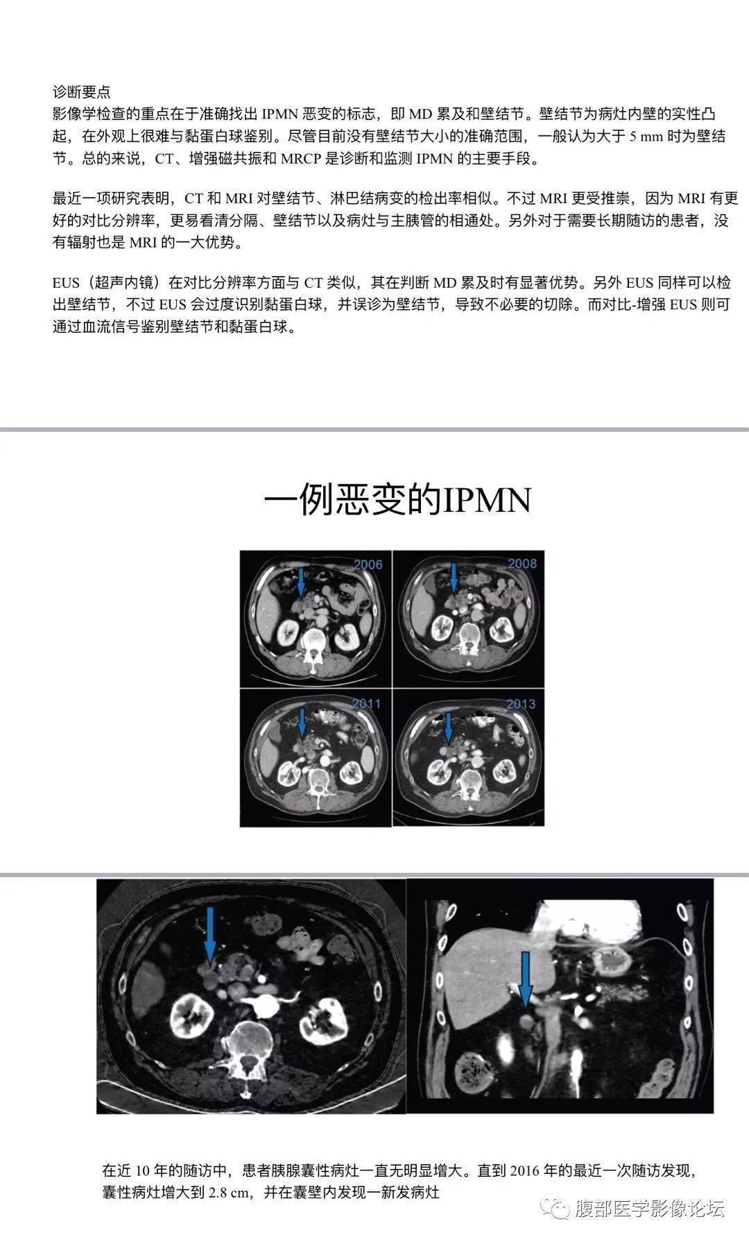 胰管型ipmn图片