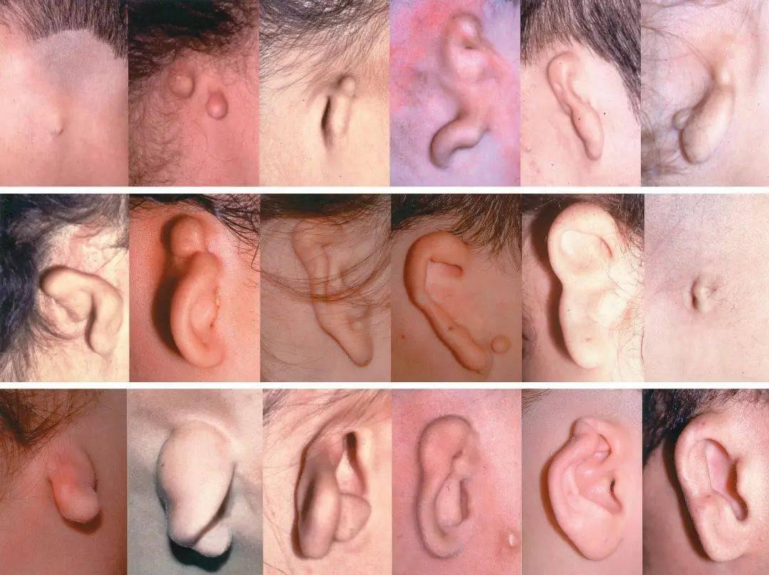 出生婴儿耳朵畸形图片图片