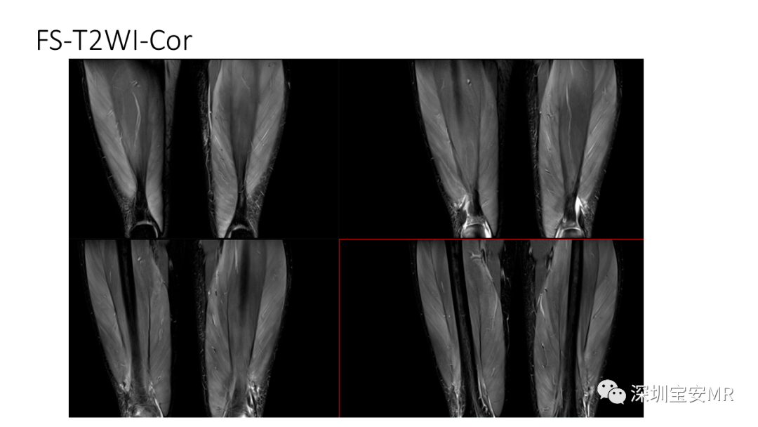 小腿肌肉解剖MRI图片