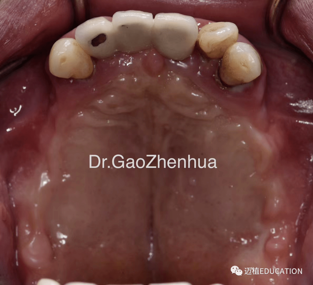 上颌后牙区因牙周炎导致上颌窦底骨量严重不足,加上上颌窦气化,结节区