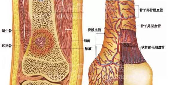 骨髓炎,一個讓你苦不堪言也能治療的炎症_手機搜狐網