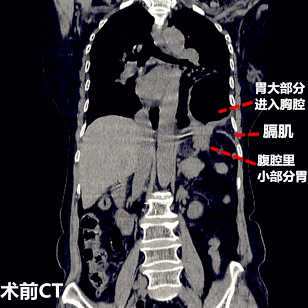 湘潭滴羅娭毑劇烈嘔吐67ct一看胃都進胸腔了