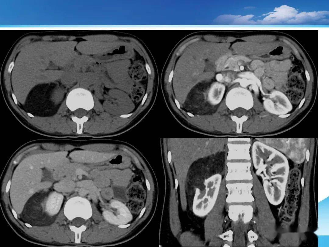 四叠体池脂肪瘤ct图片图片
