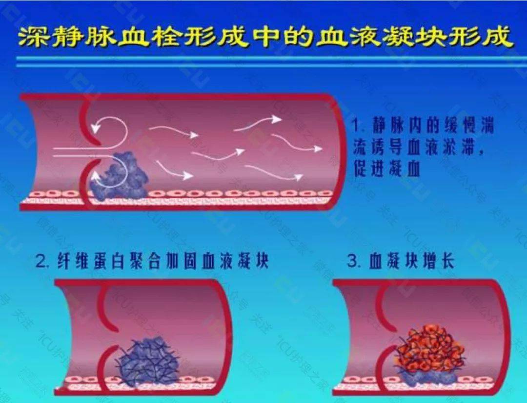 護士深靜脈血栓形成及肺栓塞的預防和護理