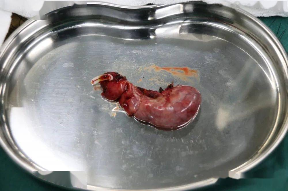【徐水中医院】我院成功切除一例罕见巨大阑尾