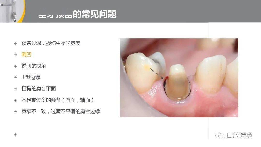 全冠的牙体预备前后牙