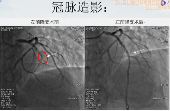 前降支狭窄或完全闭塞的st