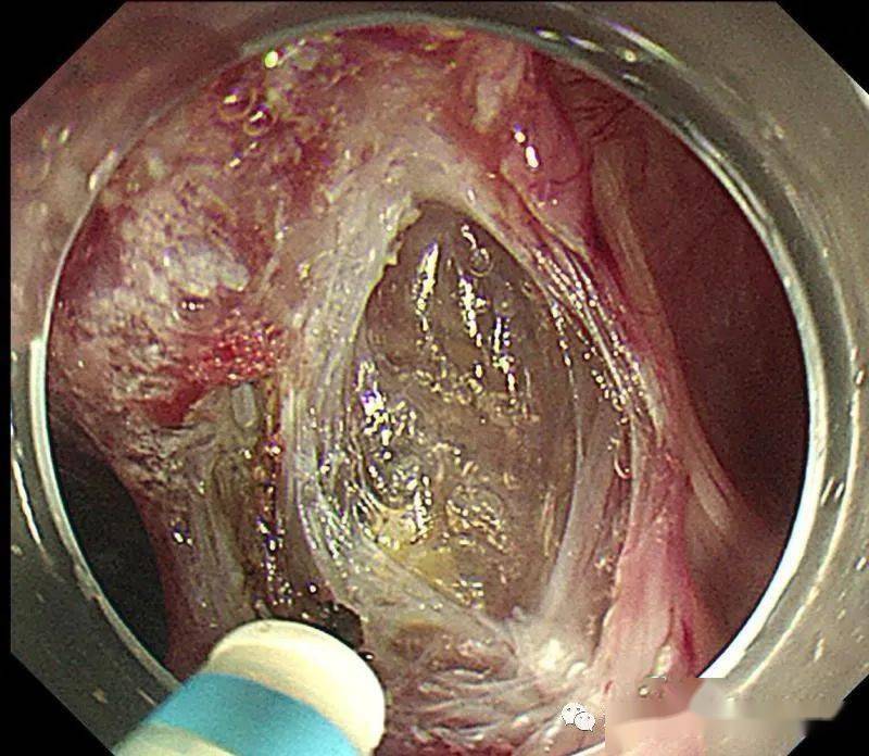 巧破堤坝治疗食管憩室