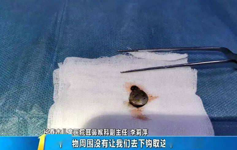 夹取也不容易,经过近20分钟,异物被成功取出,但因肿胀严重,鼻腔内结构