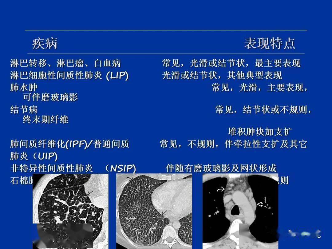 肺小葉,肺間質解剖與病變的hrct診斷