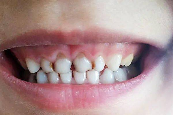 4岁男孩牙齿几乎全黑,最伤孩子牙齿的不是糖,而是