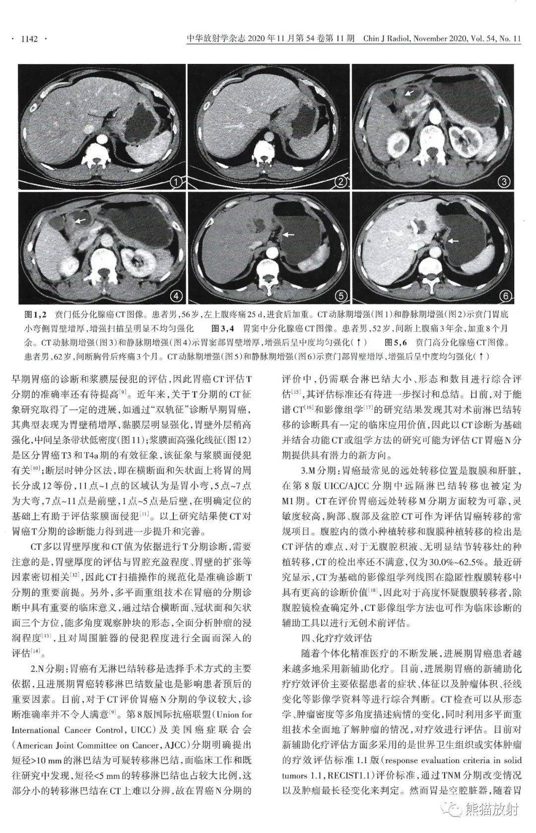 胃癌晚期ct图片及报告图片
