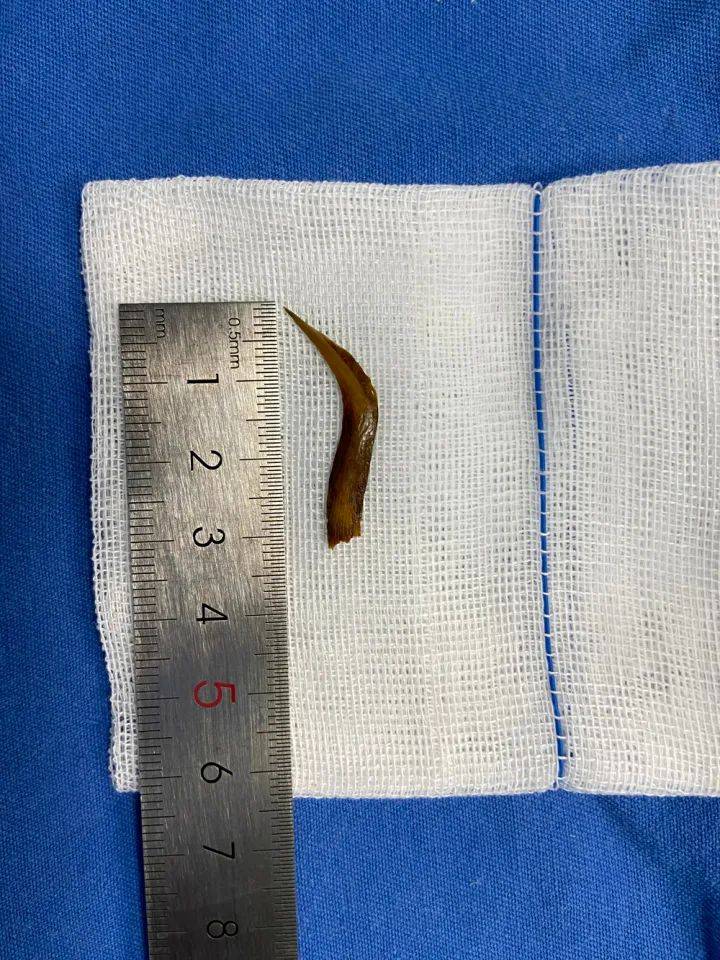 因为一根鱼刺,杭州大伯又是开颅又是开腹