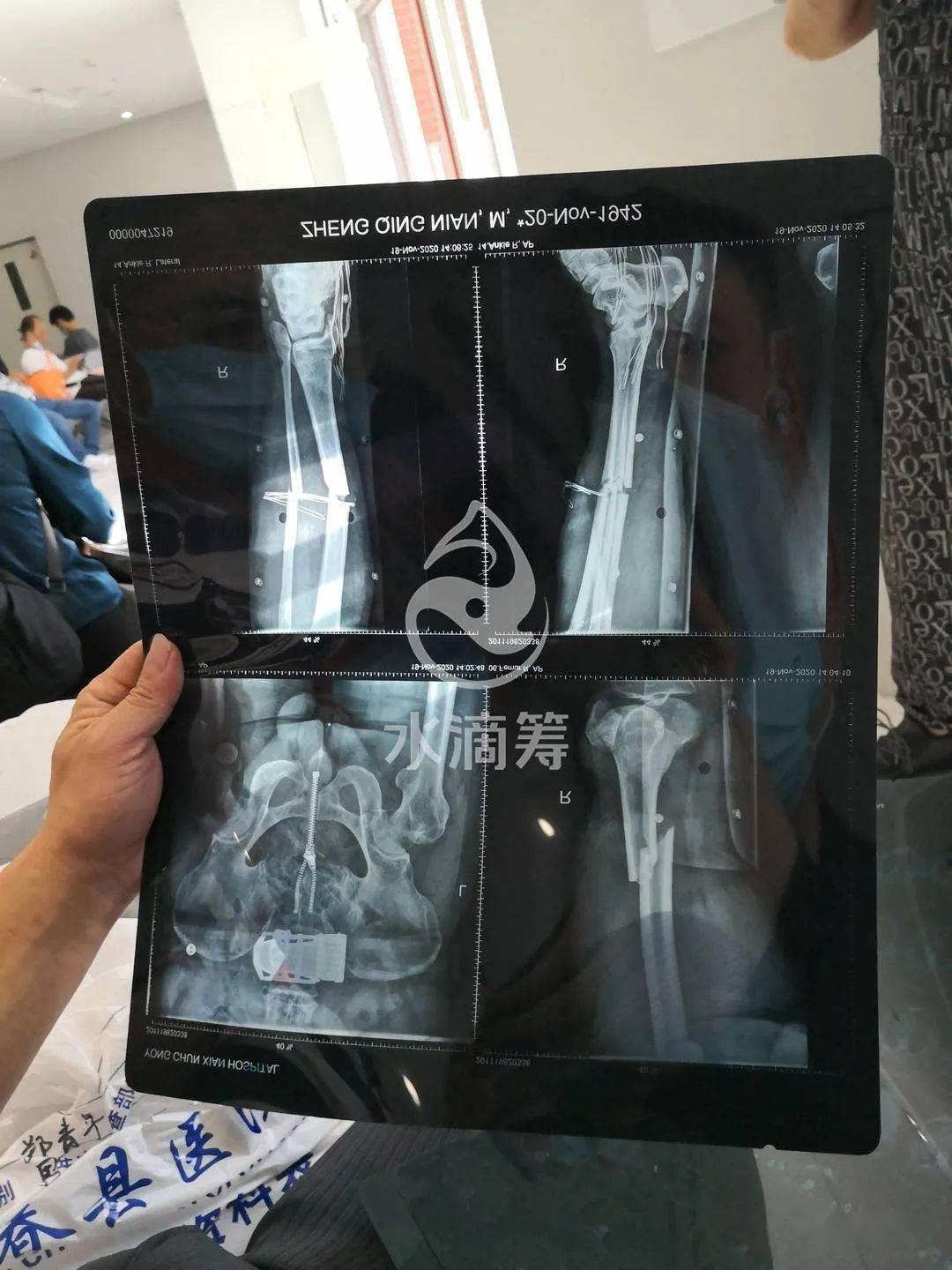 永春一男子发贴求助:父亲不幸发生车祸,全身多处骨折,恳请爱心人士